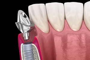 A 3D illustration of a dental implant and its abutment