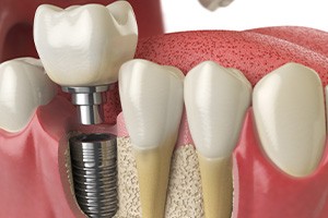 A 3D illustration of a dental implant getting its final restoration