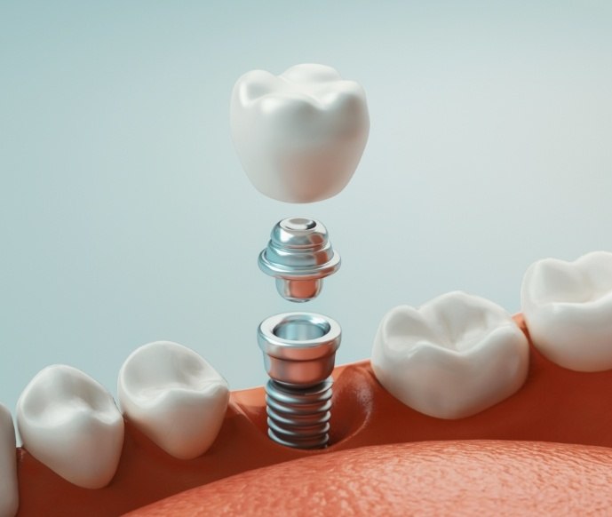 Illustration of dental implant being inserted into lower jaw with crown