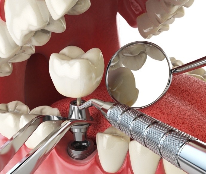 Illustration of dental implant being placed with dental instruments