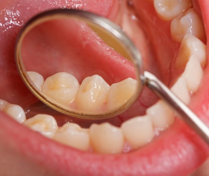 Examining teeth and gums with dental mirror