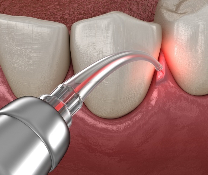 Illustration of gums receiving laser periodontal treatment