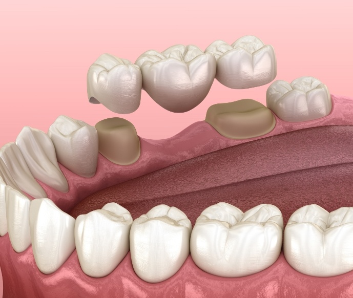 Illustration of lower arch of teeth receiving dental bridge