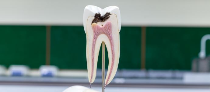 Close up of a model of a decayed tooth