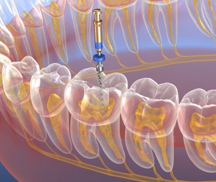 Illustration of a root canal treatment in Matthews for tooth in lower arch