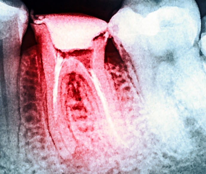 X ray showing a wisdom tooth